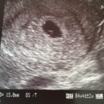 妊婦の盲腸